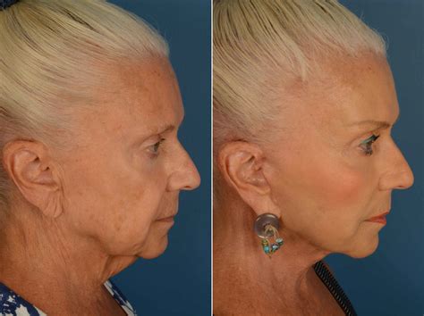Endoscopic Face Lift Set at Brendan Gates blog