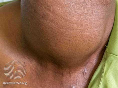 Spotting Serious Signs With a Neck Lump