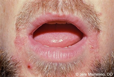 Angular Cheilitis - American Osteopathic College of Dermatology (AOCD)