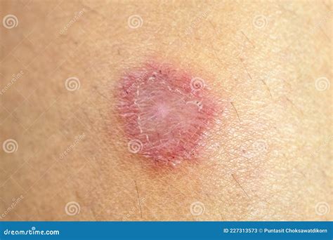 Skin Infection Caused by Mold Stock Image - Image of disease, chest ...