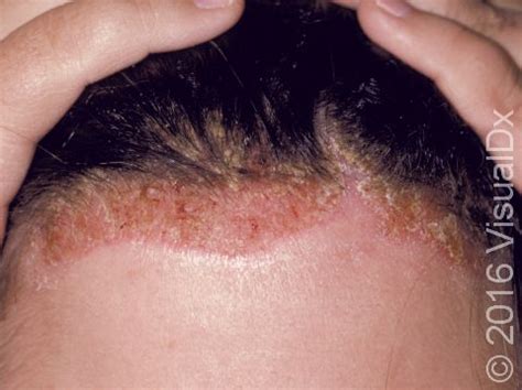 Seborrheic Dermatitis Scalp