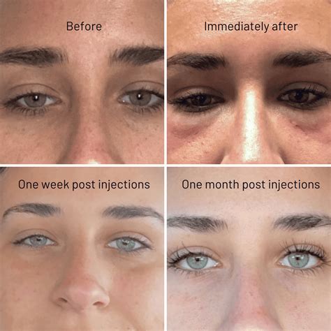 PRP Under-Eye Treatment | Innova Wellness Spa | Ocala, FL