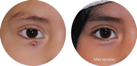 pyogenic granuloma  pasadena glendale andre panossian md