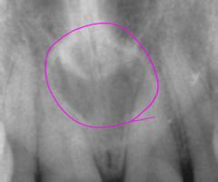 Developmental Defects & Dental Anomalies Flashcards | Quizlet