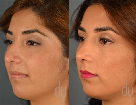 nose job men before and after