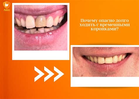 Почему опасно долго ходить с временными коронками? | Стоматология "Лана ...