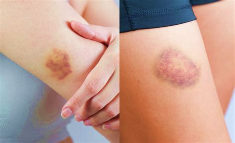 Mancha Escura No Corpo - Médicos alertam: Manchas escuras que aparecem no corpo podem ser sinais ...