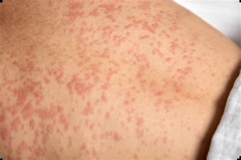 Rubéola: Síntomas, causas y prevención | Mundo Vacunas