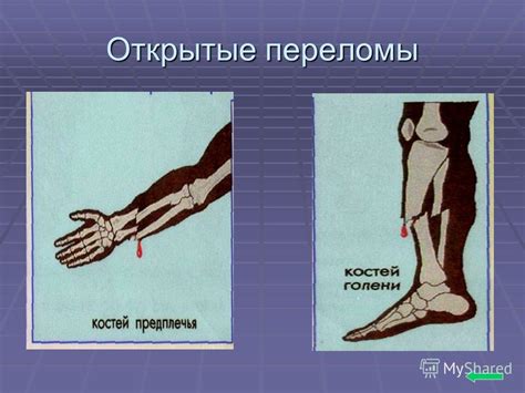 Презентация на тему: "Оказание первой помощи при травмах и переломах ...