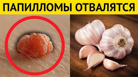 ПАПИЛЛОМЫ отсохнут с корнем. Просто каждый день наносите эти дешевые ...