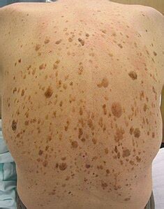 how to pronounce seborrheic keratosis