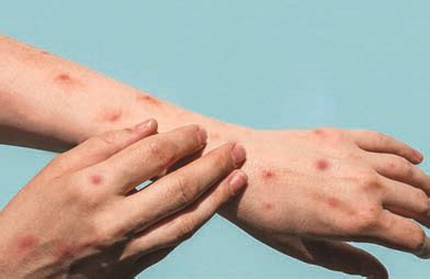 Get vaccinated against measles | Vuk'uzenzele