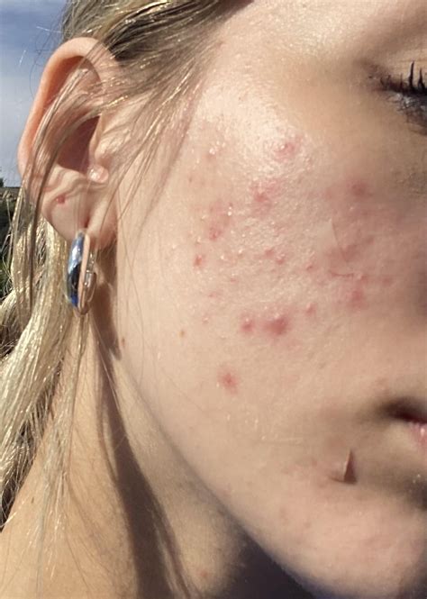 acne on only one side of face ??? : r/acne