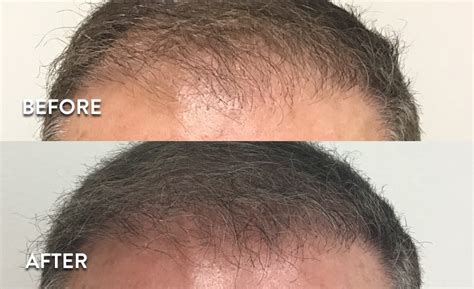 PRP Hair Loss Before & After Pictures | Hair Restoration Results Photos