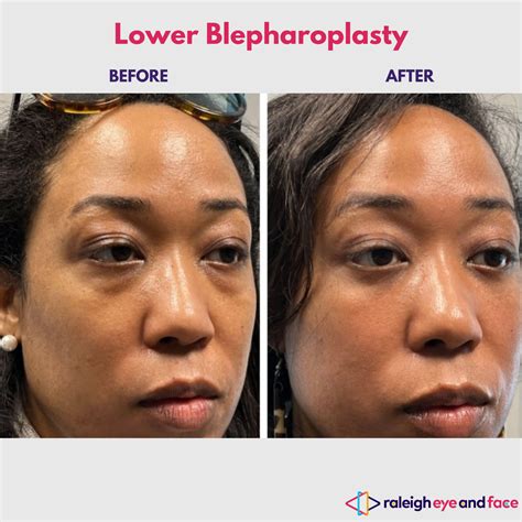 Lower Blepharoplasty Before And After Gallery — Raleigh Eye and Face