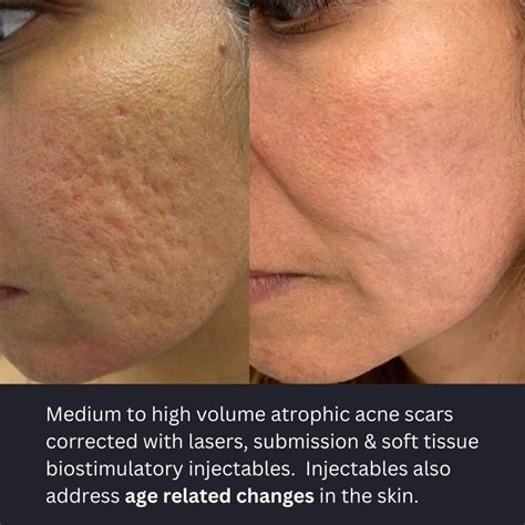 atrophic acne scars
