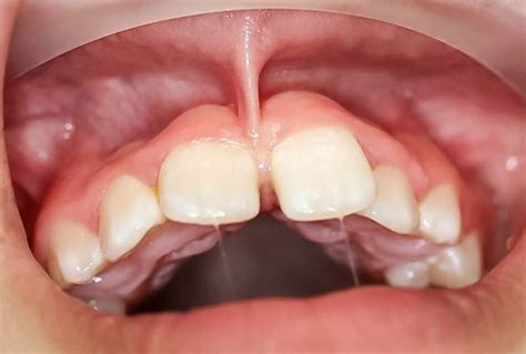 Labial Frenulum Normal