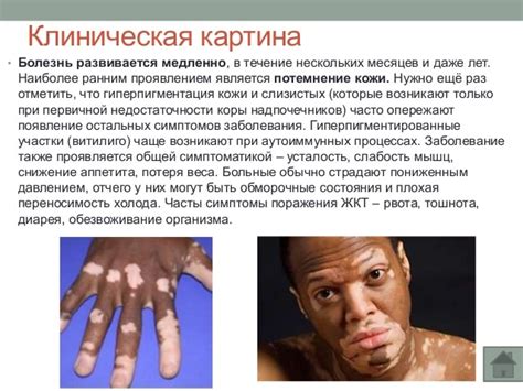 Болезнь Аддисона: симптомы, основные способы диагностики и лечения