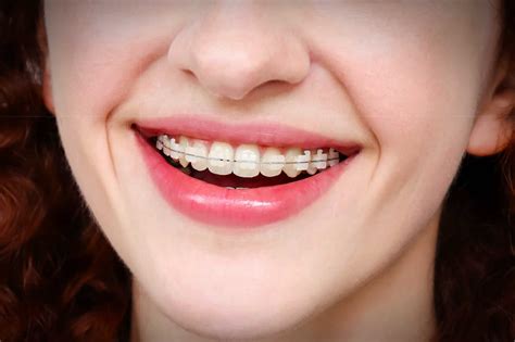 Clear Dental Braces - Prestige Orthodontics