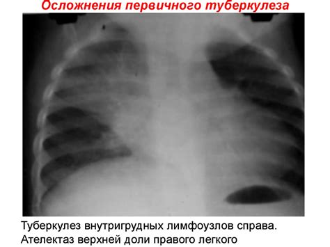Клинические формы туберкулеза - презентация онлайн