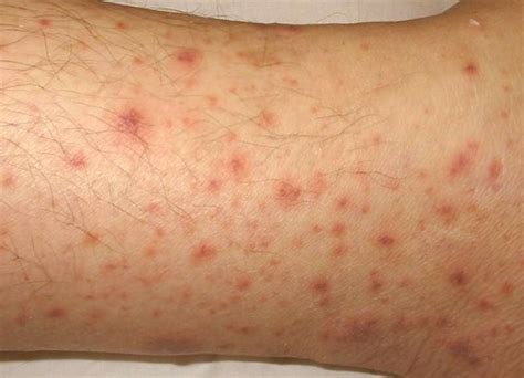 purpura pictures symptoms  treatment