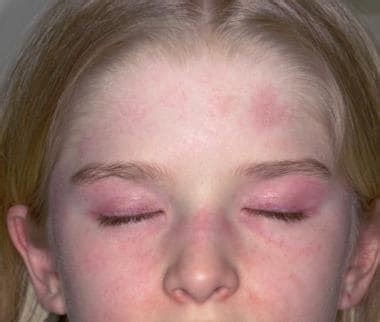Juvenile Dermatomyositis: Practice Essentials, Background, Pathophysiology