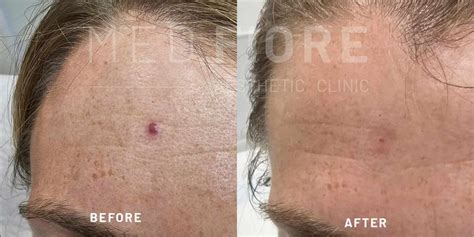 Skin Lesions Treatment Hale | Cheshire | Med Fiore