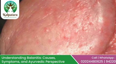 Understanding Balanitis: Causes, Symptoms, and Ayurvedic Perspective