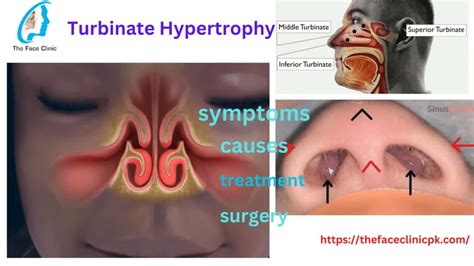Nasal Turbinate Hypertrophy - Symptoms & Treatment