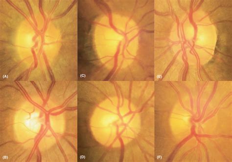 optic disc morphology  peripapillary atrophic   diabetic