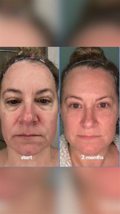 Marionette chin and jawline dermal filler injections – Artofit