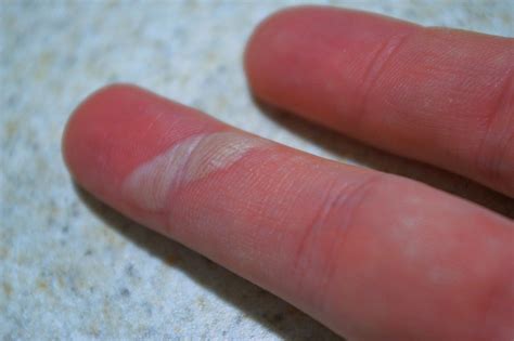Оказание первой помощи при ожогах кожи: что делать, признаки и степень ...