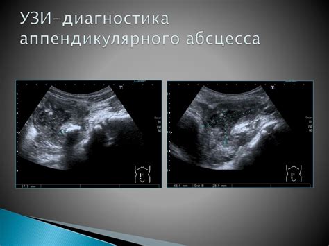 Осложнения острого аппендицита - презентация онлайн