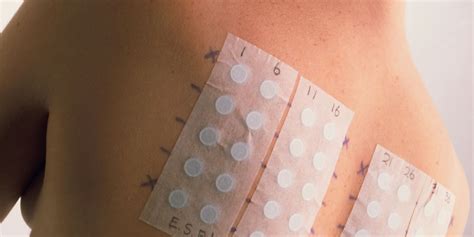 Chronic Actinic Dermatitis
