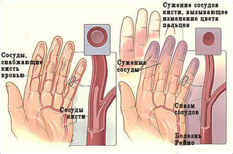 Choroba Raynauda: objawy i leczenie, fizjoterapia