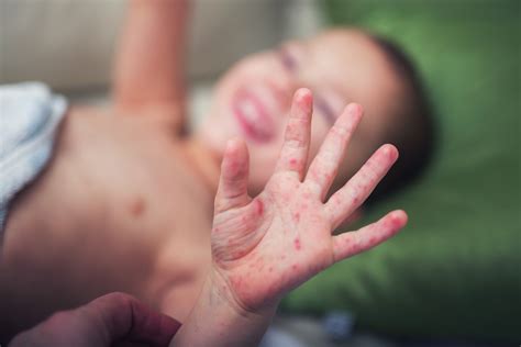 white life in: Fluid Filled Bumps On Hands