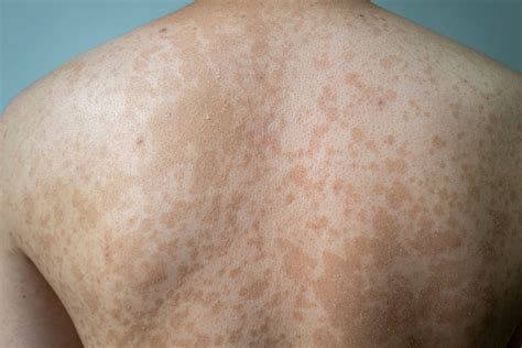 Pityriasis versicolor (tinea versicolor) - Doktr