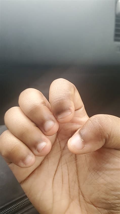 For those asking if your nail beds will grow/reattach... More in the ...