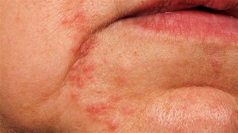 perioral dermatitis  mouth nhs  despina olson blog