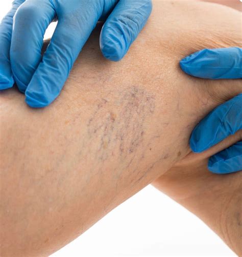 Unlocking the Secrets of Varicose Veins: What You Need to Know ...