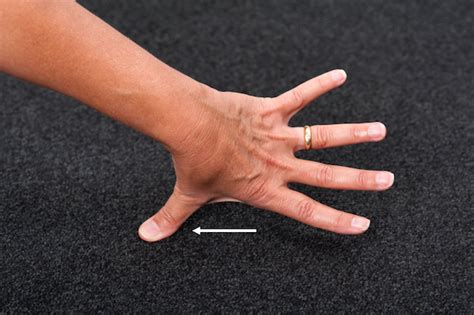 Thumb fracture