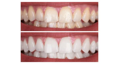 Qual O Valor De Um Clareamento Dental