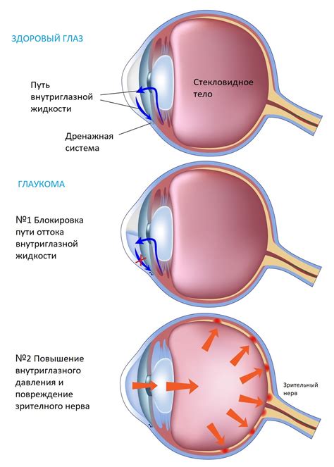 Открытоугольная и закрытоугольная глаукома - Retina