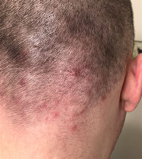 Folliculitis Scalp - vrogue.co