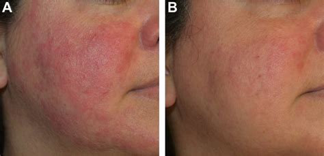 Before (A) and after (B) oxymetazoline (Afrin ® ) combined with a ...