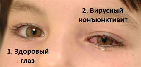 Вирусный коньюктивит: как вылечить быстро у детей, симптомы