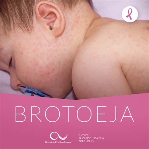 Brotoeja De Calor Em Bebe - Brotoeja: Guia Completo - Causas, Sintomas e Como Tratar - Dra. Ana ...