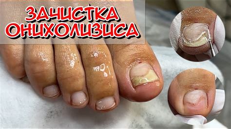 Зачистка Онихолизиса / ноготь отошел от ложа / Под ногтем пустота ...