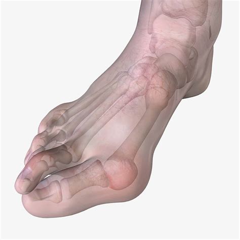 Are Bunions Hereditary? | Vargas Foot Specialists