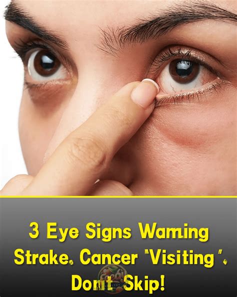 3 Eye Symptoms That Signal Hidden Health Issues: High Cholesterol